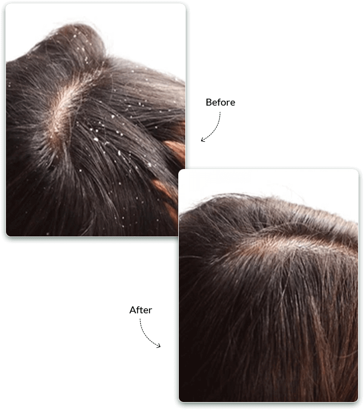 Dandruff Treatment Before and After Treatment Result