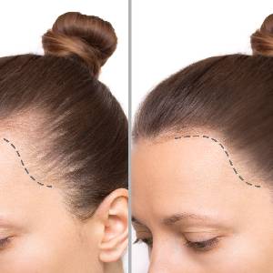Keravive Hair Treatment