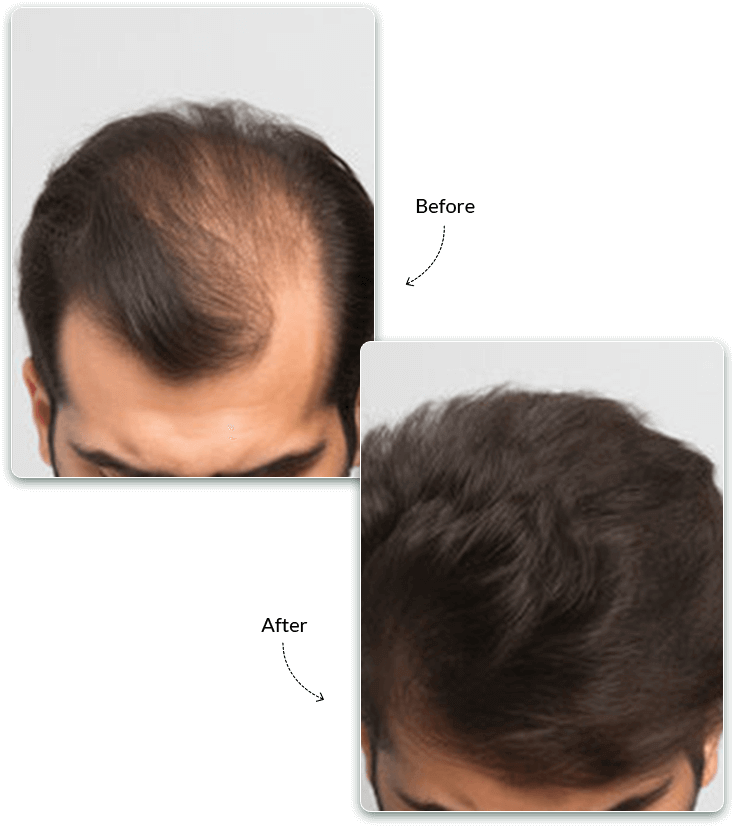 Hair Transplant Before and After Treatment Result
