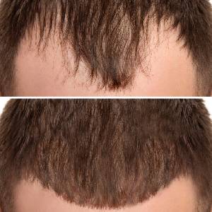 GFC for Alopecia Baldness