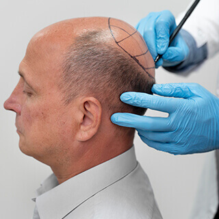 Hair Transplant