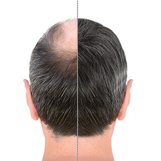 Kosmo Hair Gen Treatment