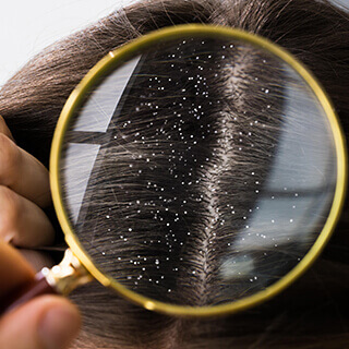 Dandruff Treatment
