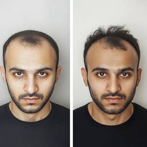 Minoxidil Scalp Treatment