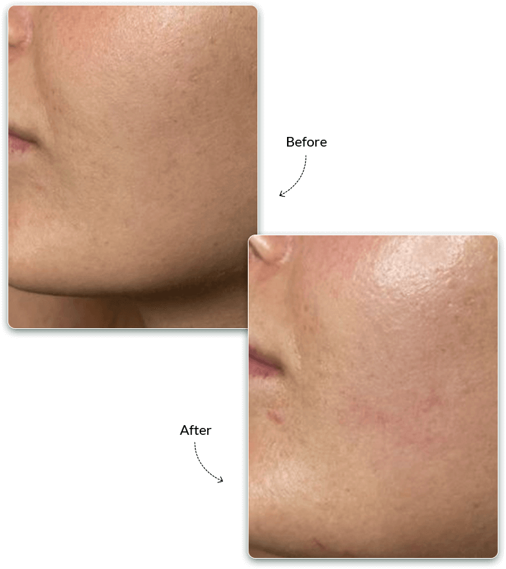 Hollywood Facial Before and After Treatment Result