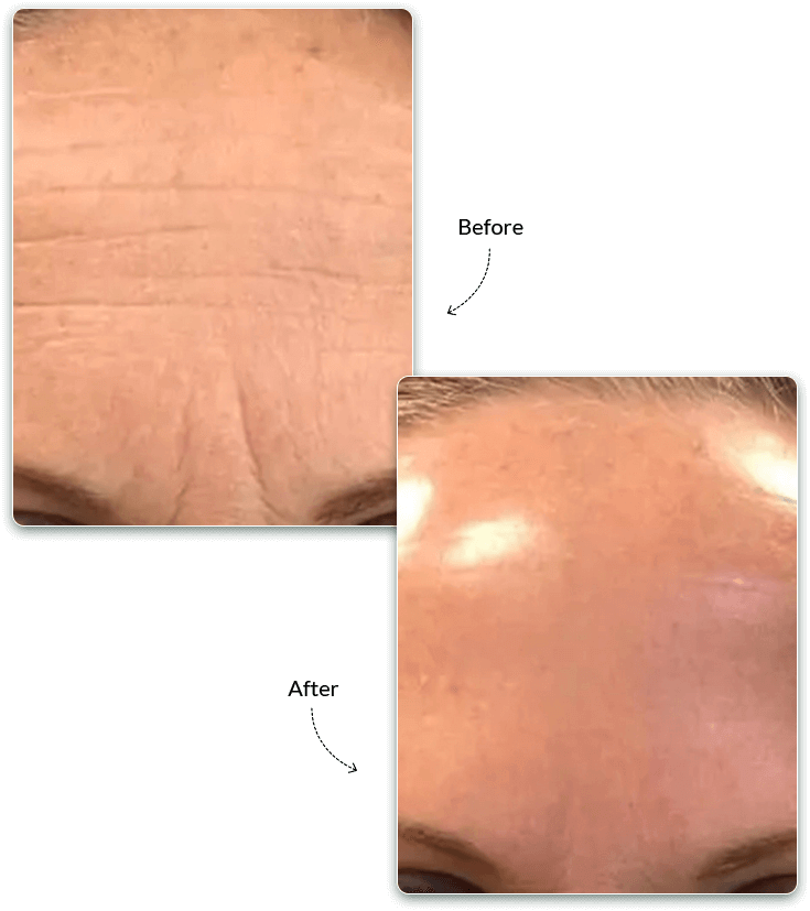 Hydrafacial Before and After Treatment Result
