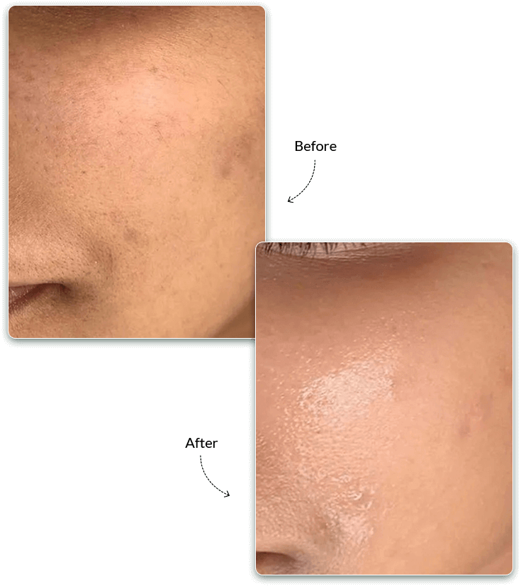 KosmoGlow Before and After Treatment Result