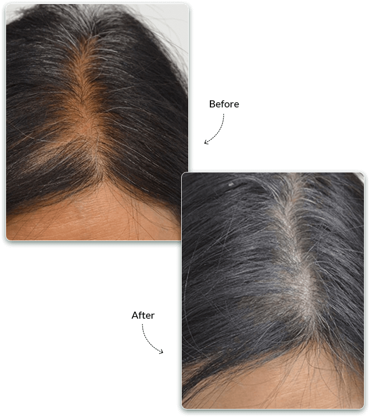 Kosmo Hair Gen Before and After Treatment Result