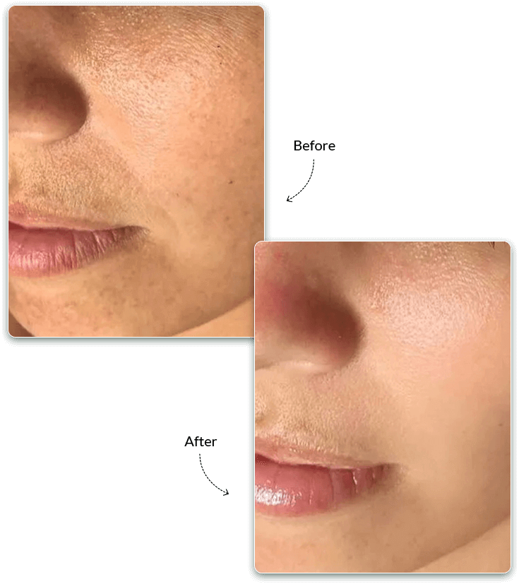Medifacial Before and After Treatment Result