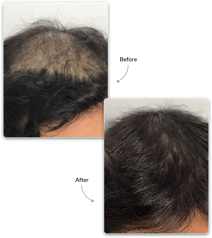 PRP Before and After Treatment Result
