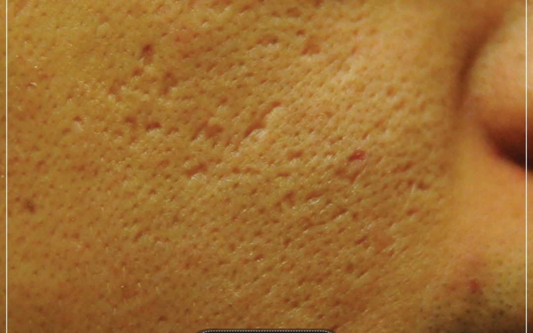 guide-to-your-acne-scars