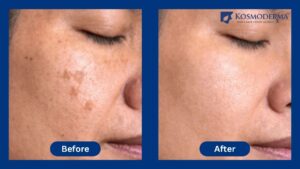 Before and After Results of Chemical Peeling for Pigmentation