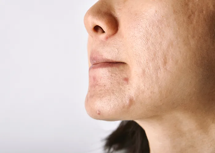 Plastic Surgery for Acne Scars