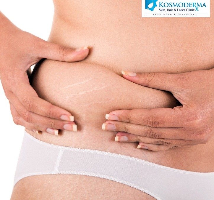 Don’t Stretch it for too Long | Kosmoderma