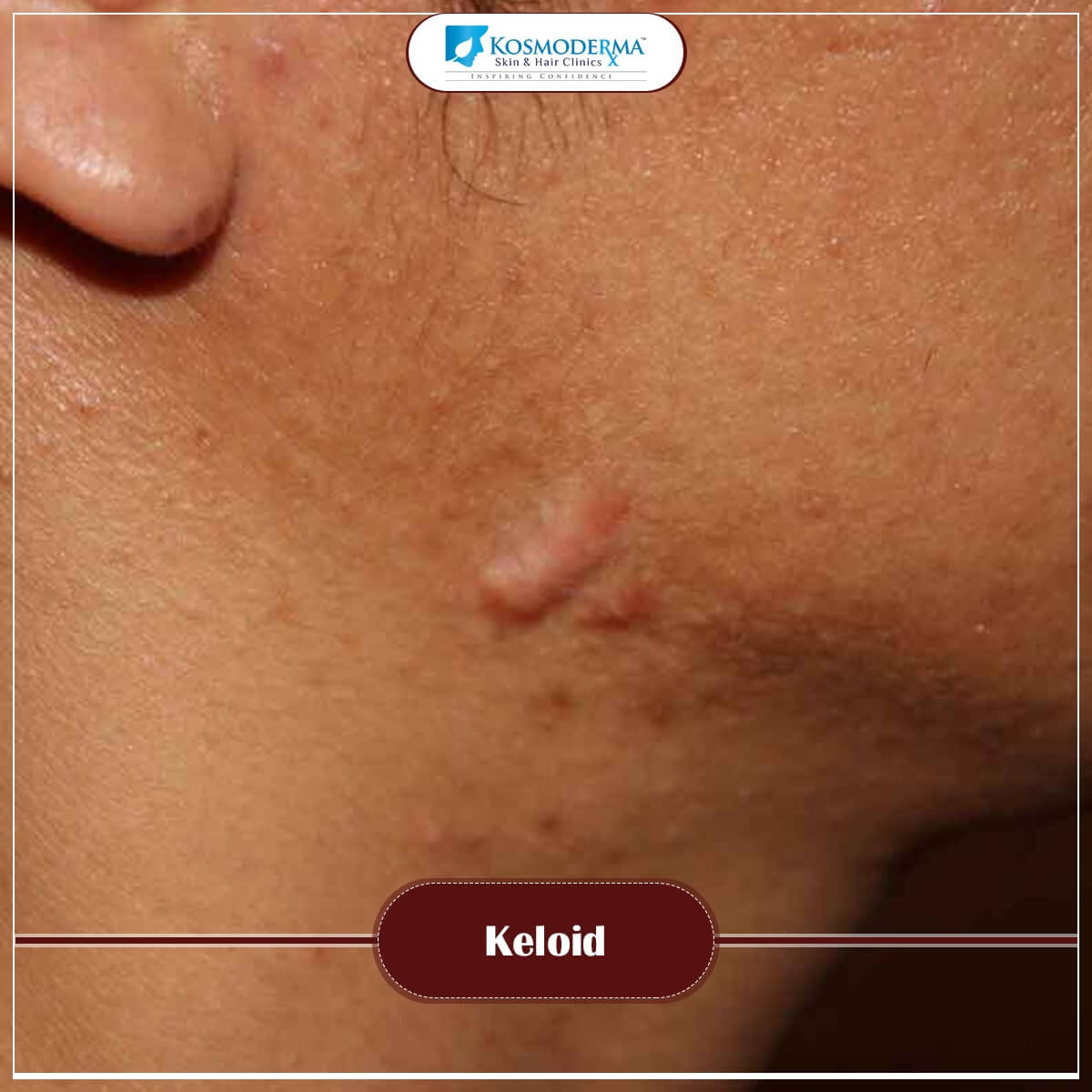 Keloid Scars