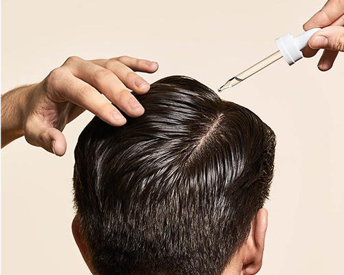 Can You Use Minoxidil For Temple Hair Loss?