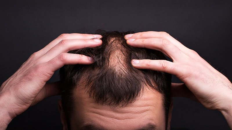 Hair Loss on Temples: Causes & Treatments - Kosmoderma