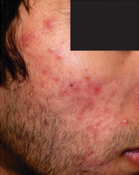 Kosmoderma Acne Treatment Bangalore