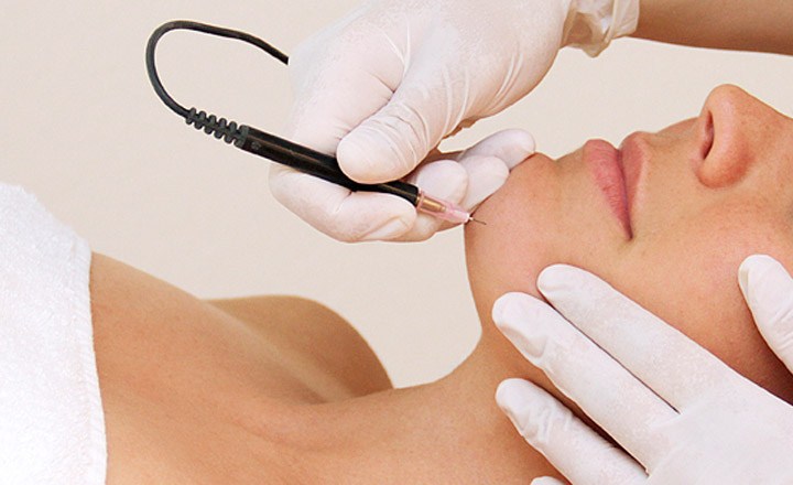 Everything You Need to Know Before You Get Electrolysis Hair Removal -  Kosmoderma