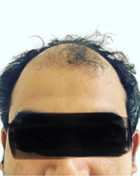 Kosmoderma Skin Specialist for Hair Loss Bangalore