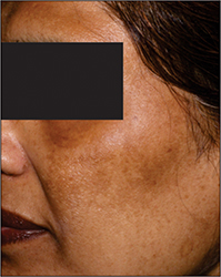 Kosmoderma Pigmentation Treatment Bangalore