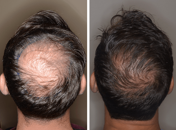 Pros and Cons of Hair Transplant - Kosmoderma