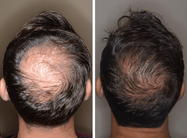 Hair Transplant