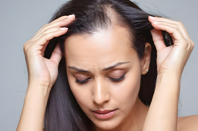 Baldness & Hair Loss Treatment for Men & Women - Kosmoderma