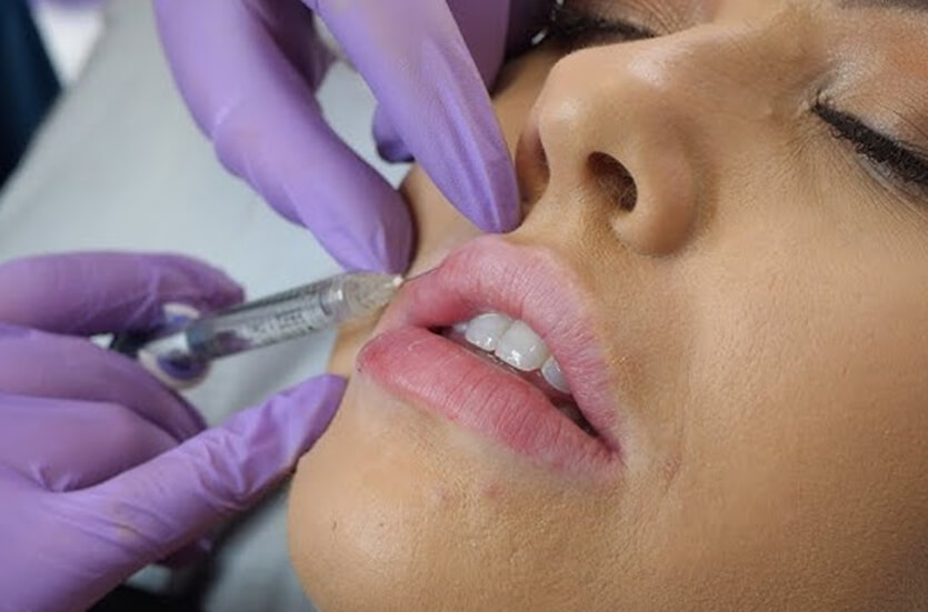 A Guide To Dissolving And Refilling Lip Fillers | Kosmoderma