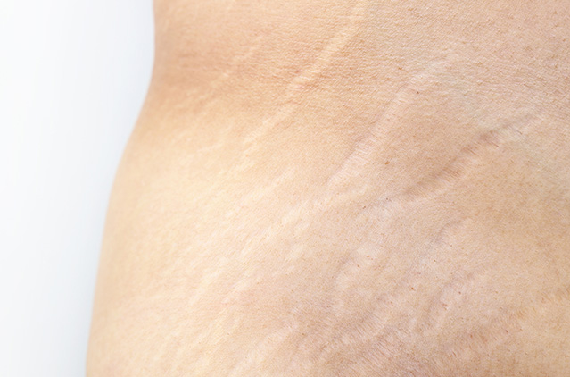 Stretch Marks, Be Gone! Unlock Radiant Skin with Microdermabrasion in Chennai | Kosmoderma