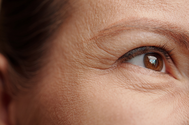 How to Treat Under-Eye Wrinkles: Botox vs. Dermal Fillers | Kosmoderma
