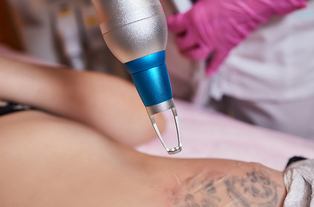 Laser Tattoo Removal in Chennai | Kosmoderma