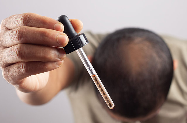 Does the Minoxidil Solution Really Stop Hair Fall? | Kosmoderma