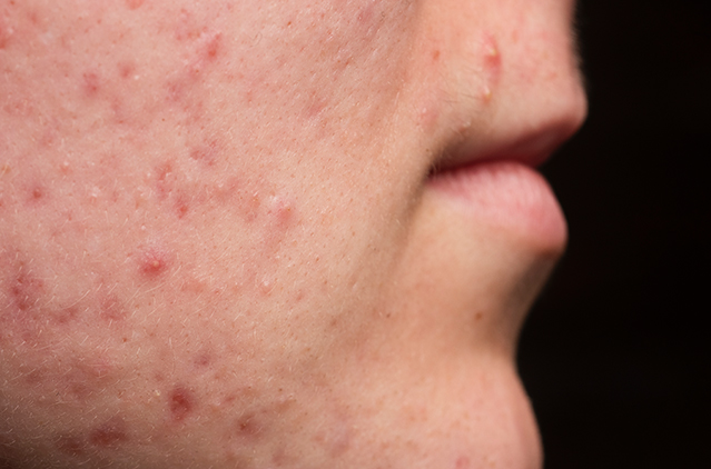 Advanced Acne And Pimple Treatments – For A Spotless Complexion | Kosmoderma