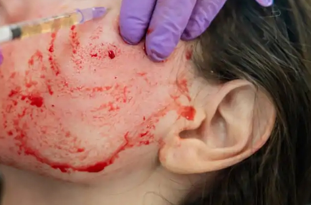 Flaunt The Coveted Plumped-up Look With The Innovative Vampire Facelift! | Kosmoderma