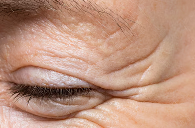 Crow’s Feet Is Treatable With Seamless Skin Care Procedures! | Kosmoderma