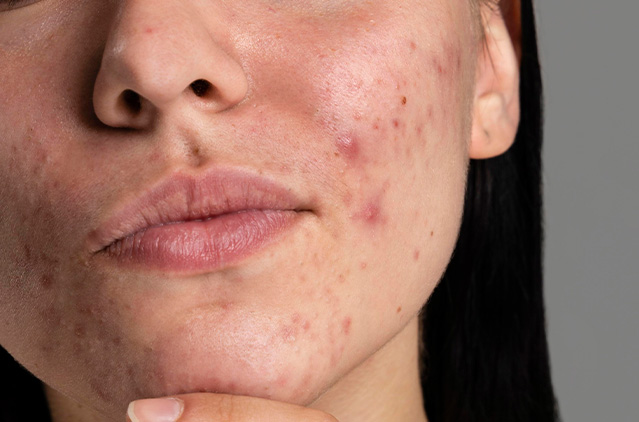 Chemical Peels: Your Guide To Acne Prevention & Treatment! | Kosmoderma