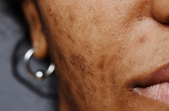 Unveiled: The Top Anti-pigmentation Treatments In 2025! | Kosmoderma