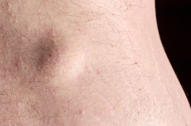 Lipoma: Causes, Symptoms, Types & Removal Treatments | Kosmoderma