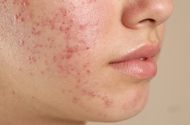 Come, Fall In Love With Your New, Oil-free Look! | Kosmoderma