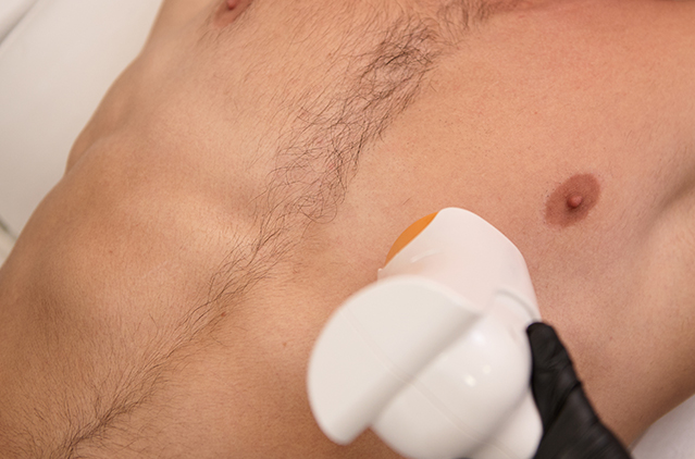 Laser Hair Removal for Men: Chest, Back & Beard | Kosmoderma