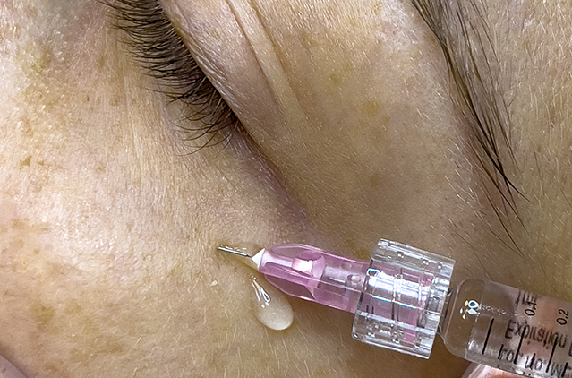 Does NCTF Therapy Hurt? What to Expect During Treatment? | Kosmoderma