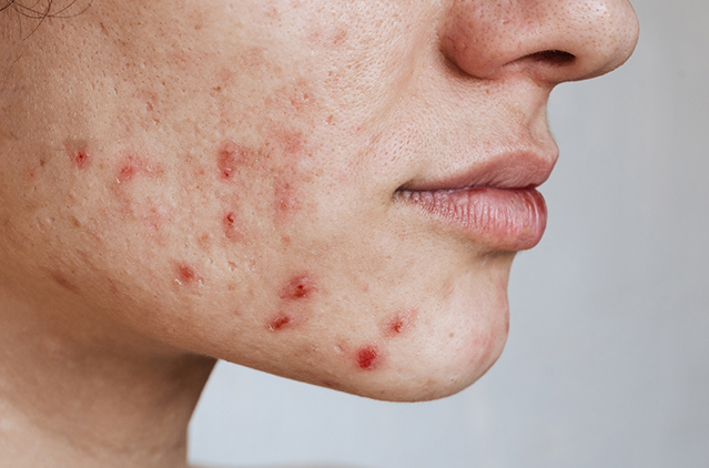 Glass Skin Treatments for Acne Scars & Hyperpigmentation: The Ultimate Guide | Kosmoderma