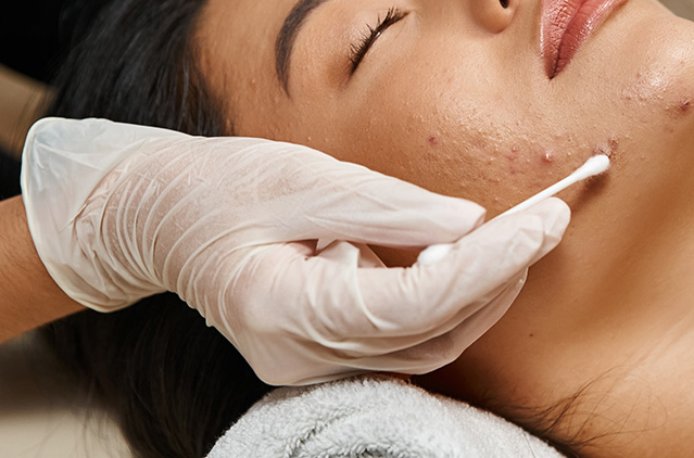 Decoded: The Role Of Chemical Peels In Treating Open, Enlarged Pores! | Kosmoderma