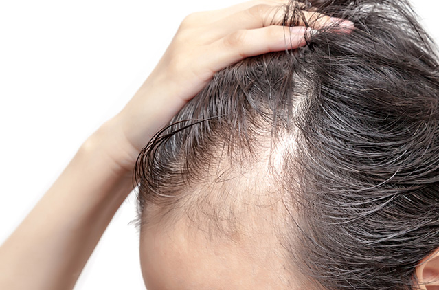 Beware: Ignore These Early Signs Of Hair Loss And Aggravate Your Condition At Your Own Peril! | Kosmoderma
