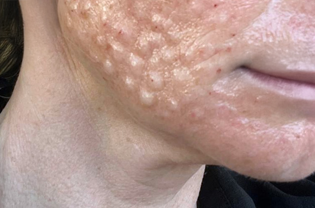 Are Salmon Sperm Facials Gross Or Advantageous? You Decide! | Kosmoderma