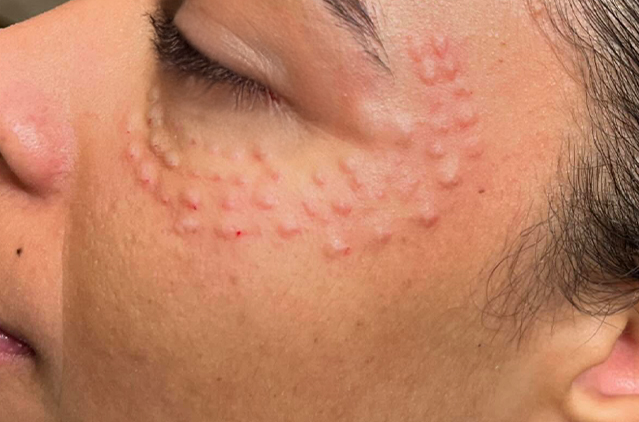 Salmon Sperm Facial: Myths vs Facts | Kosmoderma