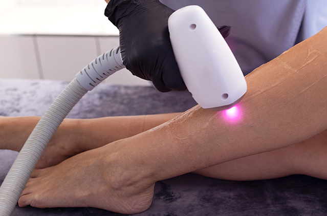 Why Bangaloreans Choose Kosmoderma for Laser Hair Removal Services | Kosmoderma