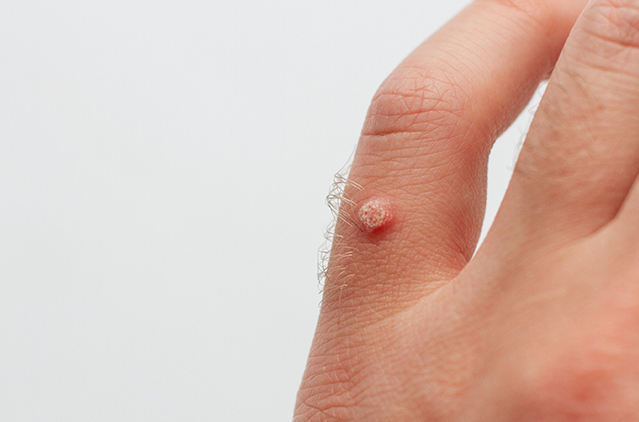 Are Warts Contagious? How to Prevent Spreading Them and Which Removal Method Works Best — Laser or Cryotherapy? | Kosmoderma