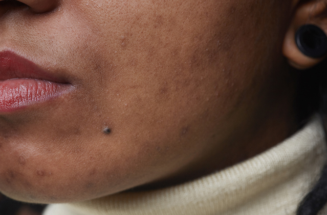 Subcision for Acne Scars: How It Works, Recovery Tips, and Before & After Results | Kosmoderma